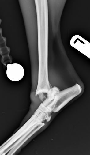 Figure 1. Comminuted talar and distal fibular fractures lateral view